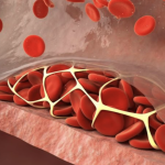International Normalized Ratio (INR) Targets: Venous Thromboembolism 